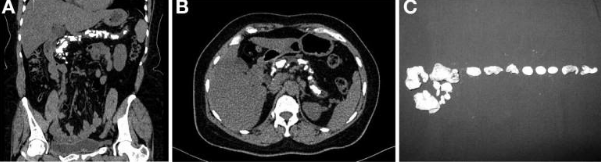 Hình ảnh cắt lớp vi tính viêm tụy mạn với teo nhu mô và sỏi toàn bộ tuyến tụy