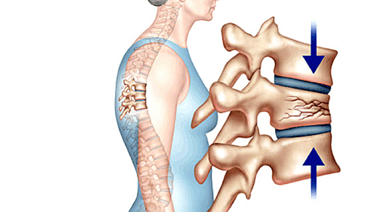 Lún xẹp đốt sống