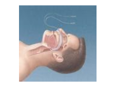 khai thông đường thở