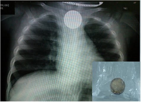 nội soi phế quản lấy dị vật phế quản