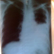 Tràn máu màng phổi