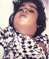 Trẻ bị sưng cổ do nhiễm trùng bạch hầu