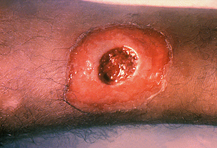 Một tổn thương da bạch hầu ở chân