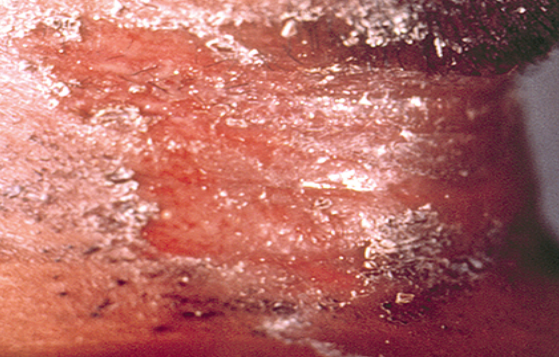 Tổn thương da bạch hầu trên cổ