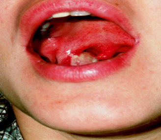 Màng bạch hầu giai đoạn đầu trên amidan phải của bệnh nhân nữ 26 tuổi