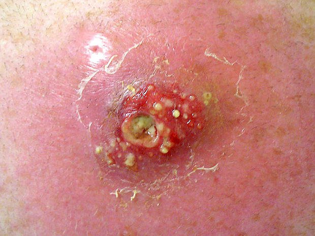 Bệnh bạch hầu ở da