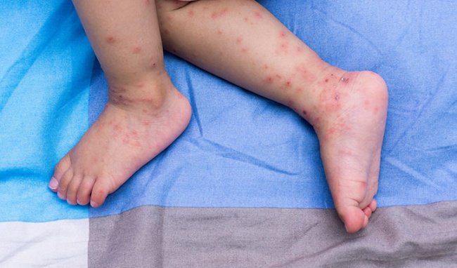 Dấu hiệu của tay chân miệng