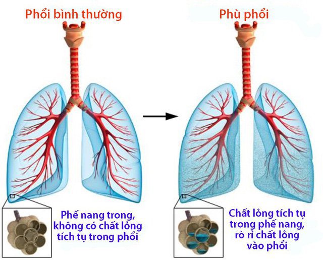 Phù phổi cấp là dấu hiệu của tay chân miệng độ 4
