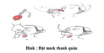gây mê Mask thanh quản