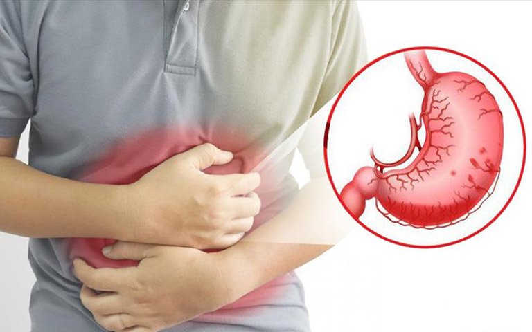 Viêm trợt hang vị dạ dày