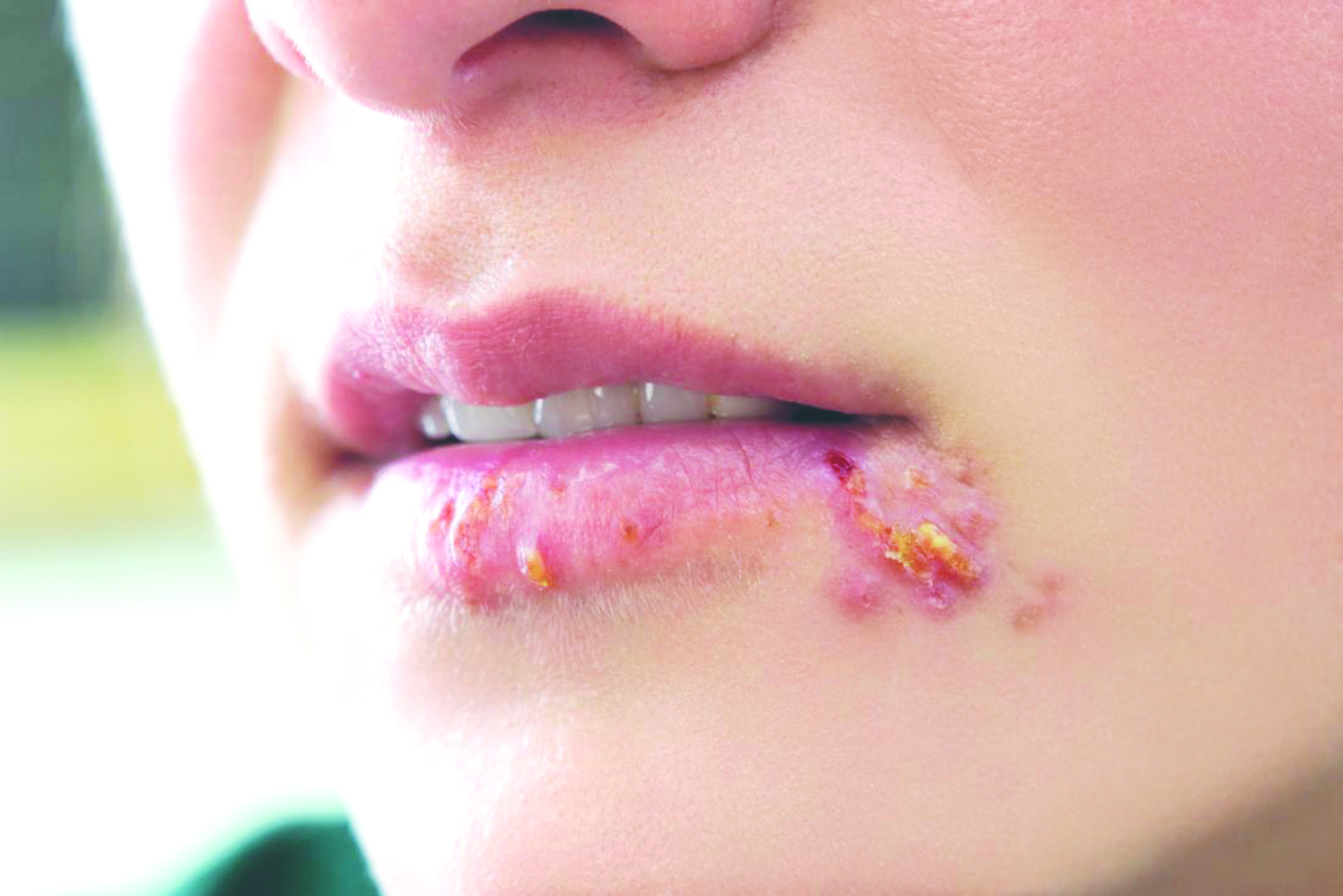 Viêm miệng herpes
