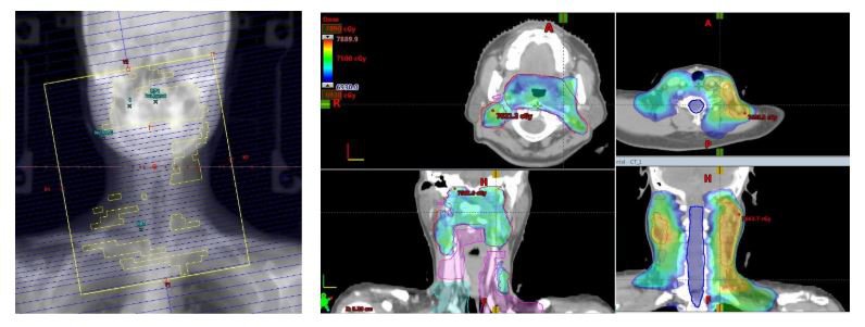 Thiết kế trường chiếu (cung quay) và lập kế hoạch xạ trị VMAT đảm bảo cấp dữ liều vào khối u và tránh các cơ quan lành xung quanh.