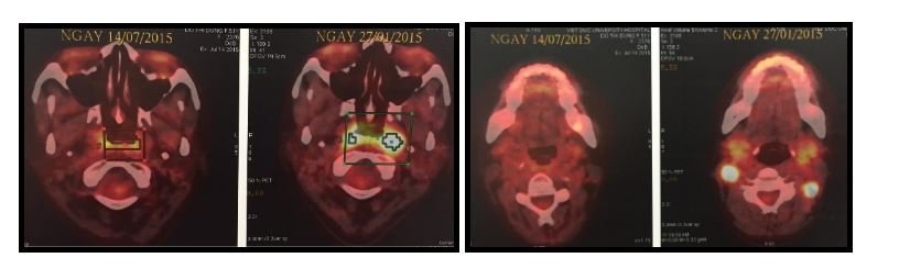 Hình ảnh chụp PET-CT sau 6 tháng điều trị cho thấy khối u đã bị tiêu diệt hoàn toàn.