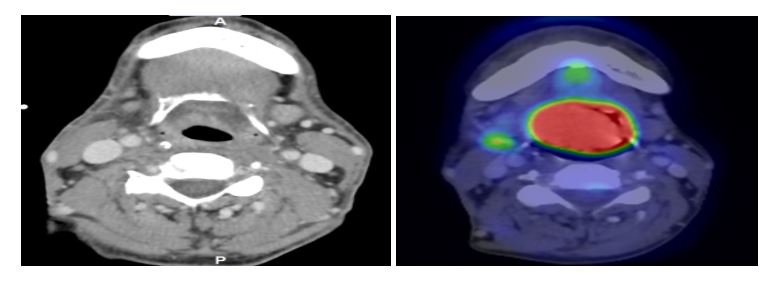 Hình ảnh chụp trước và sau 9 tháng điều trị khối u đã tiêu hoàn toàn.