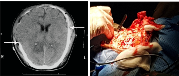 Chấn thương sọ não
