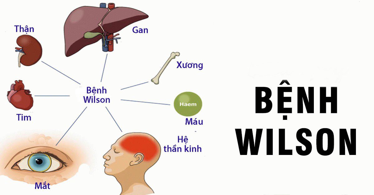 Bệnh lý Wilson