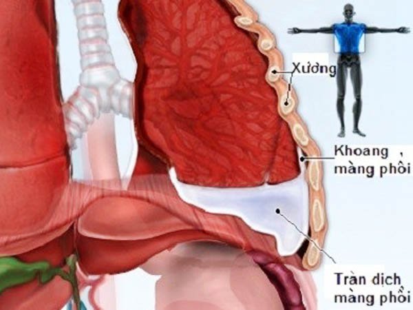 Tràn dịch màng phổi