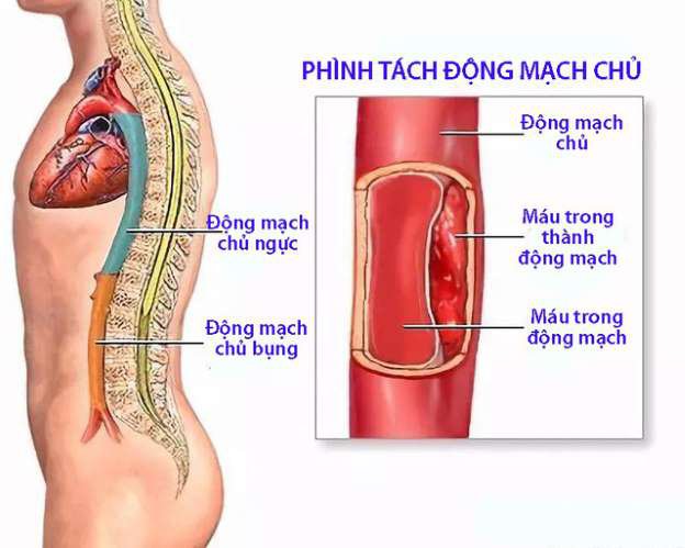 Phình tách động mạch chủ ngực