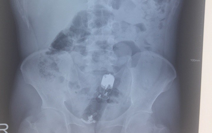 dị vật trực tràng.