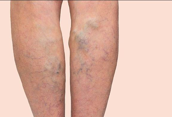 Huyết khối tĩnh mạch sâu chi dưới