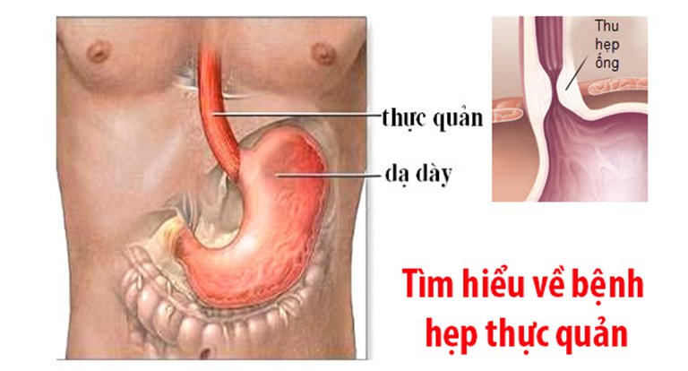 Điều trị hẹp tắc thực quản dưới hướng dẫn của chụp số hóa xóa nền