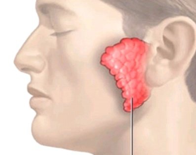 Teo tinh hoàn do mắc bệnh quai bị