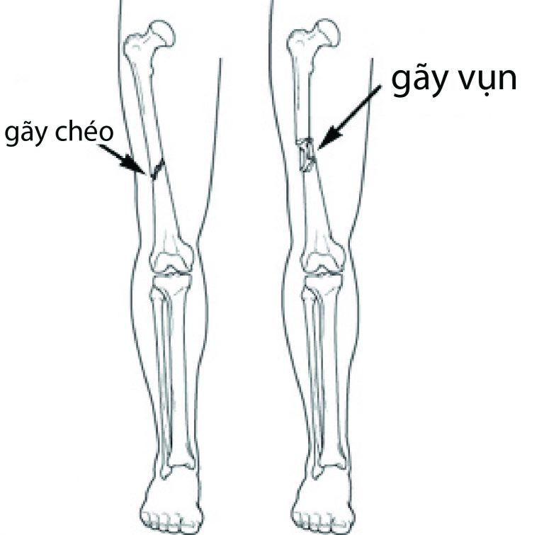 Gãy xương đùi