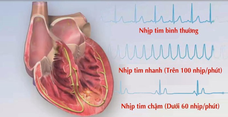 Bệnh nhân có thể bị rối loạn nhịp tim khi gây mê nội khí quản