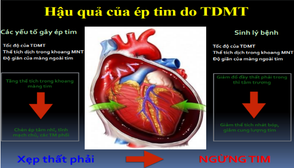 Hậu quả ép tim do TDMT