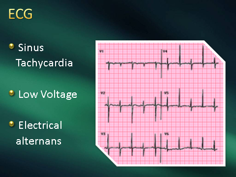 ECG