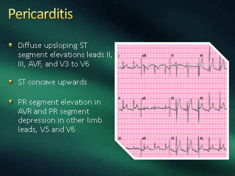 ECG