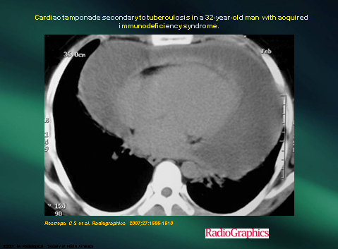 CT scanner ngực