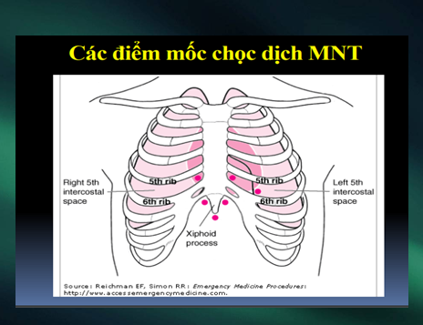 Các điểm mốc chạm dịch MNT