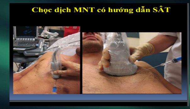 Dùng siêu âm định hướng.