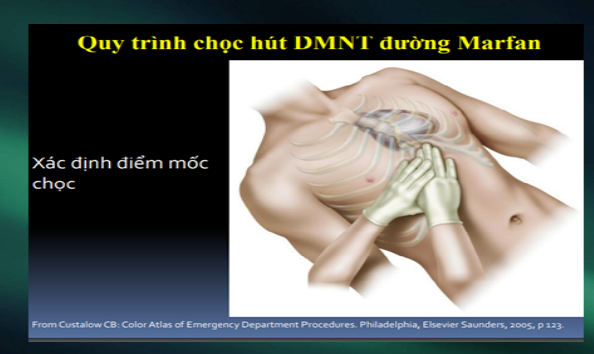 Dùng siêu âm định hướng.