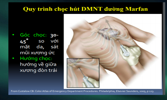 Dùng siêu âm định hướng.