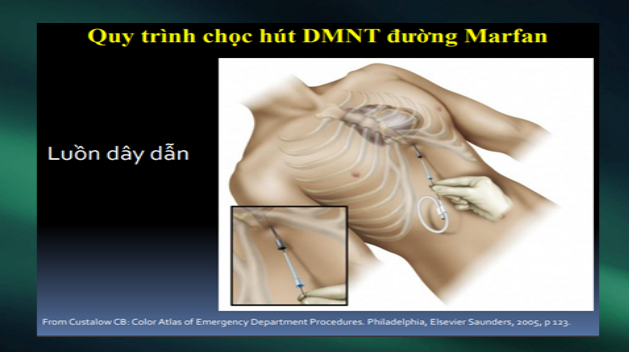 Dùng siêu âm định hướng.