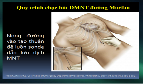 Dùng siêu âm định hướng.