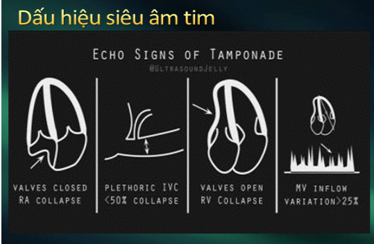 Siêu âm tim