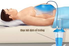 Chọc hút dịch xoang bụng