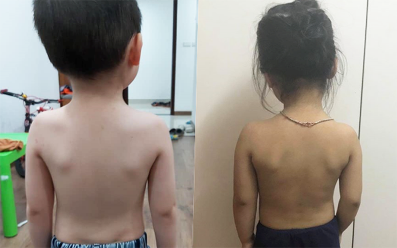 cong vẹo cột sống