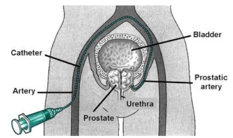 nút mạch tiền liệt tuyến