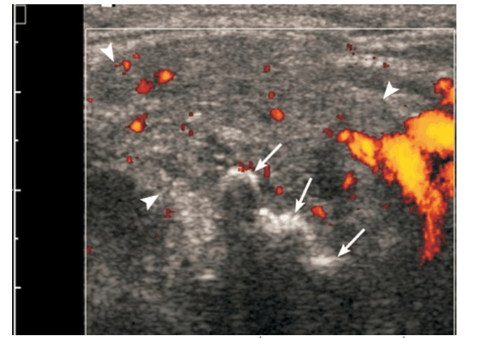 Siêu âm có thể chẩn đoán viêm tuyến nước bọt