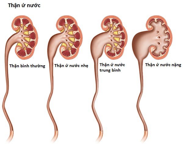 Tắc nghẽn tiết niệu