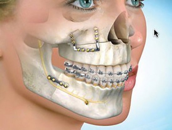 Cố định xương