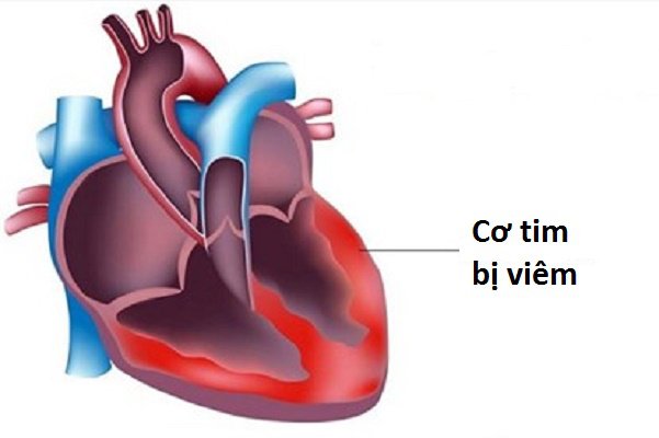 Bệnh bạch hầu có tái phát, mắc lại không? - ảnh 1