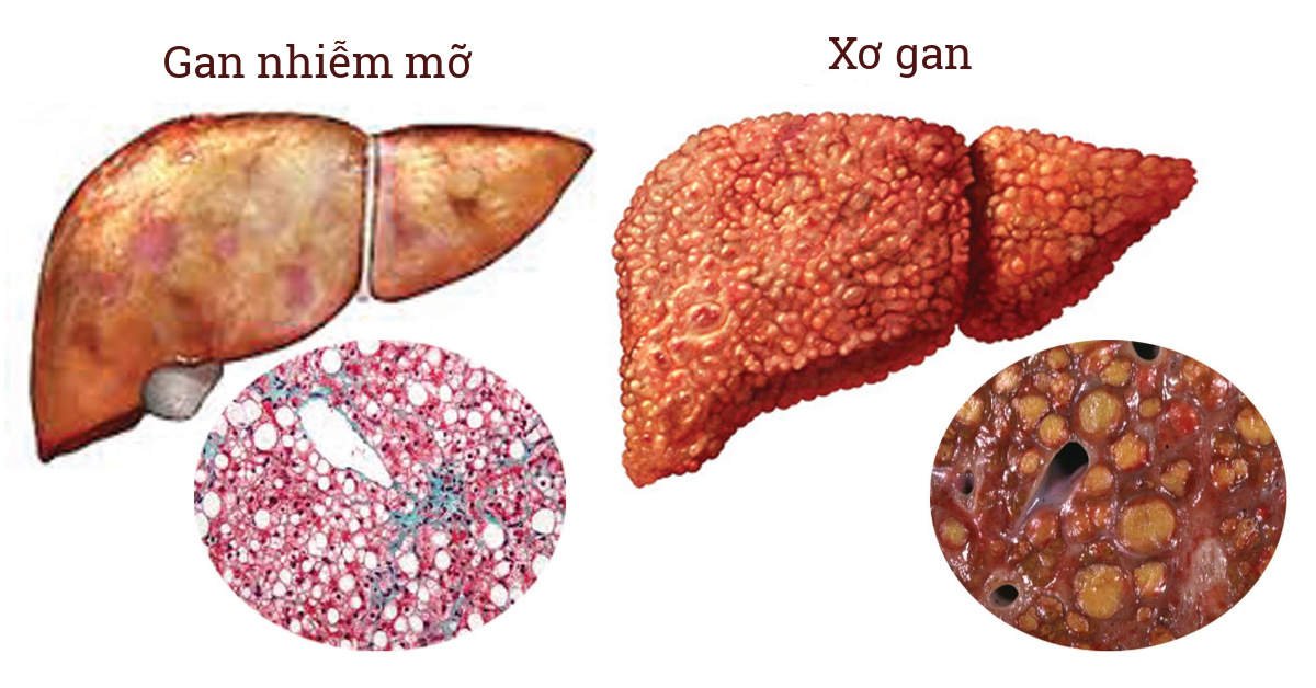 Trẻ em mắc gan nhiễm mỡ