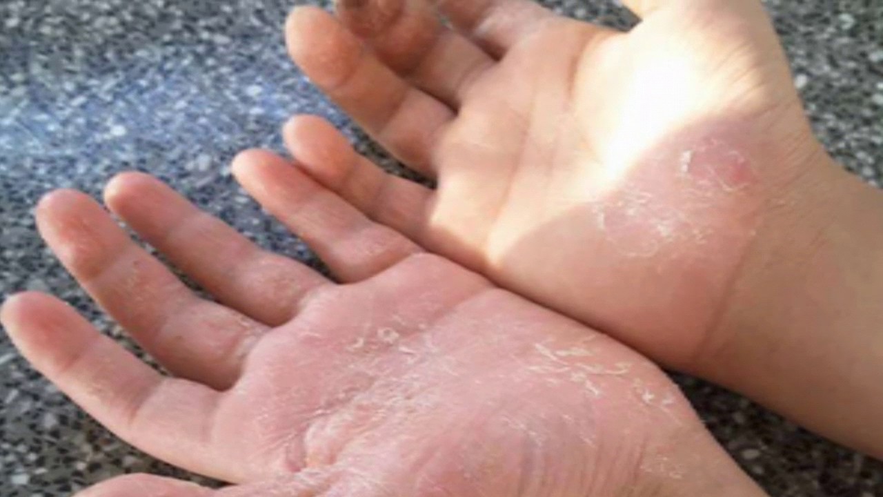 Á sừng - Hình ảnh minh họa