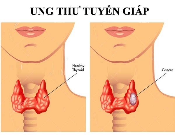 The thyroid gland carcinoma - Hình ảnh minh họa